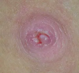 Chapped Nipple Breastfeeding Picture