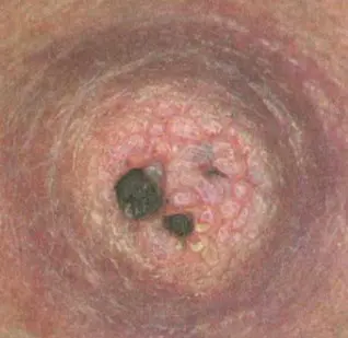 Scab Nipple Breastfeeding Or Pumping