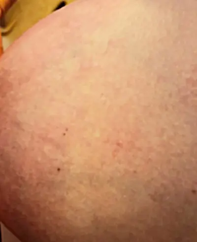 Clogged Milk Duct Picture