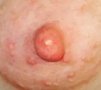Blister On Areola Or Breast